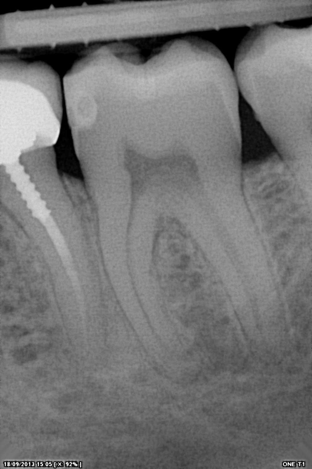 سنسور رادیوگرافی تک دندان مدل One