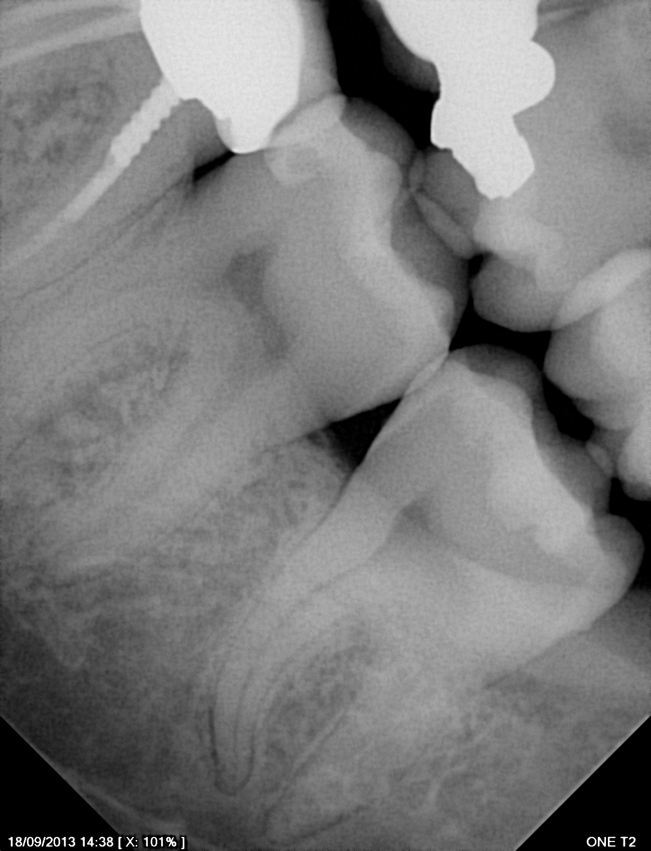 سنسور رادیوگرافی تک دندان مدل One