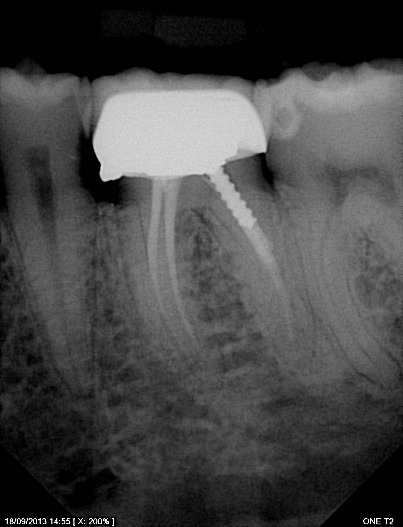 سنسور رادیوگرافی تک دندان مدل One