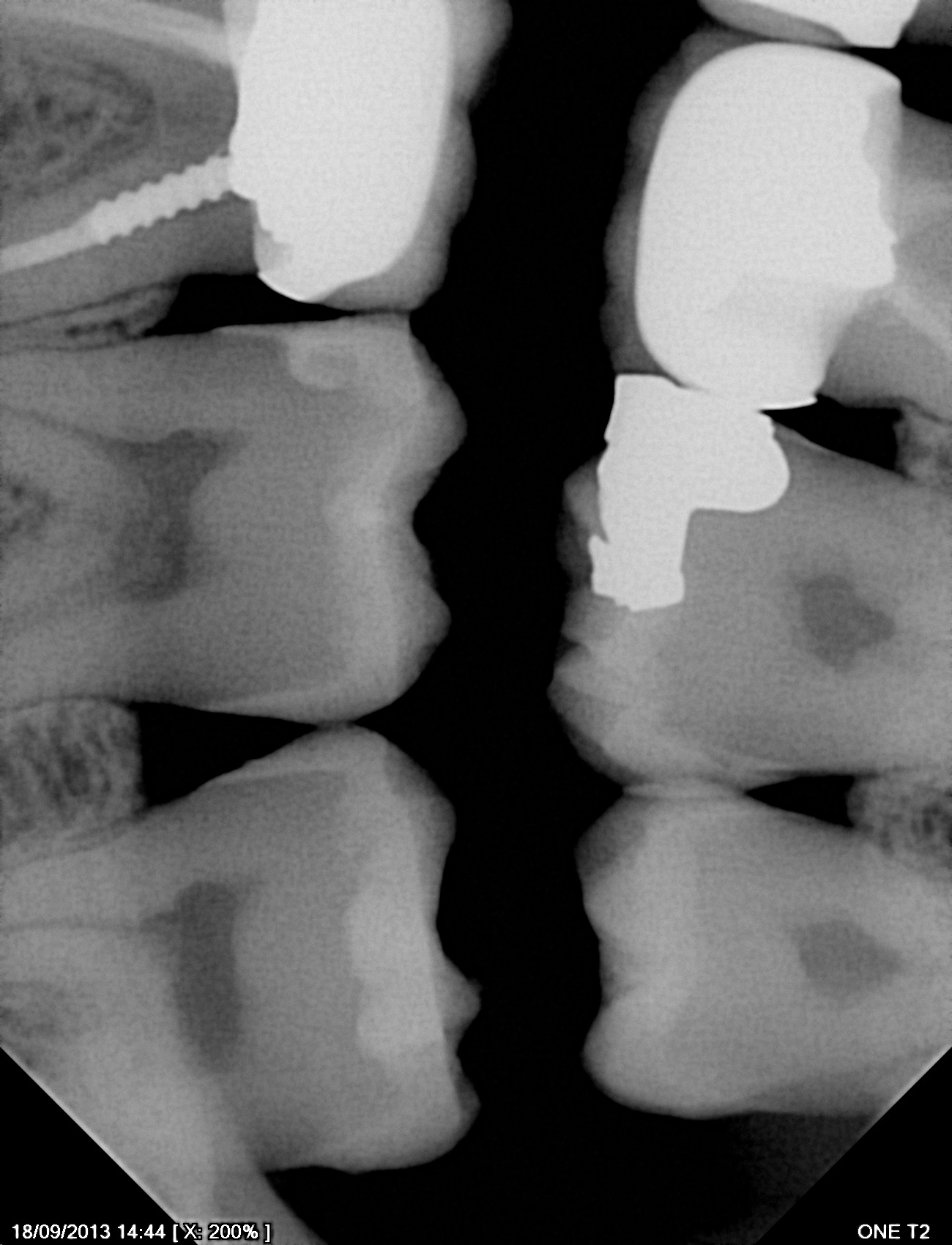 سنسور رادیوگرافی تک دندان مدل One