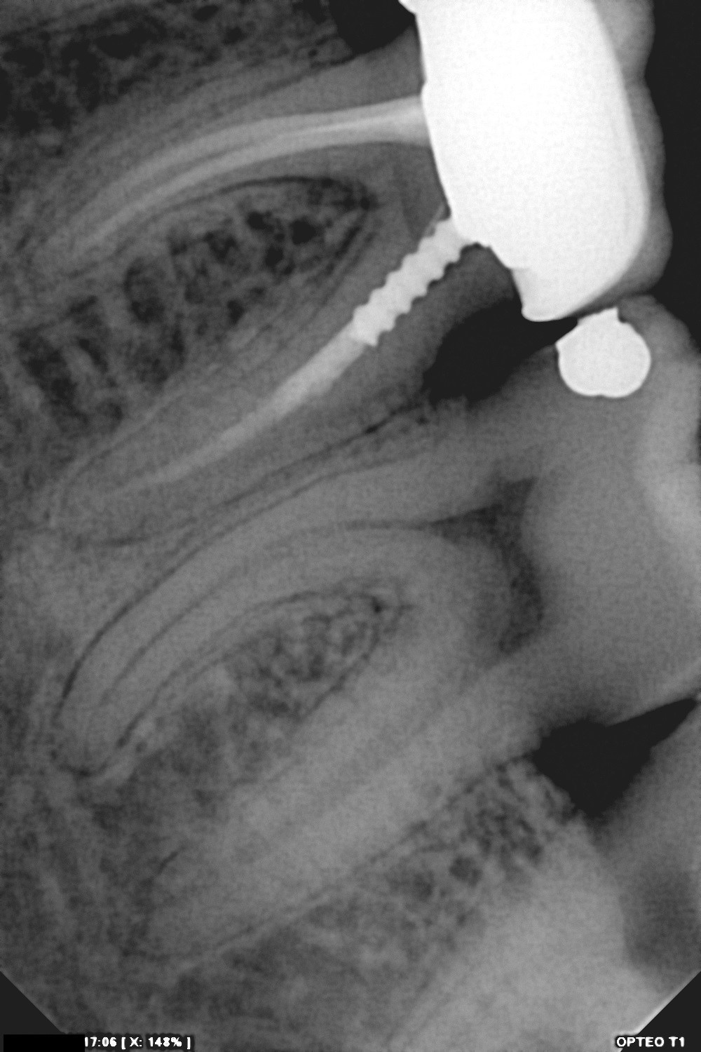 سنسور رادیوگرافی تک دندان مدل OPTEO