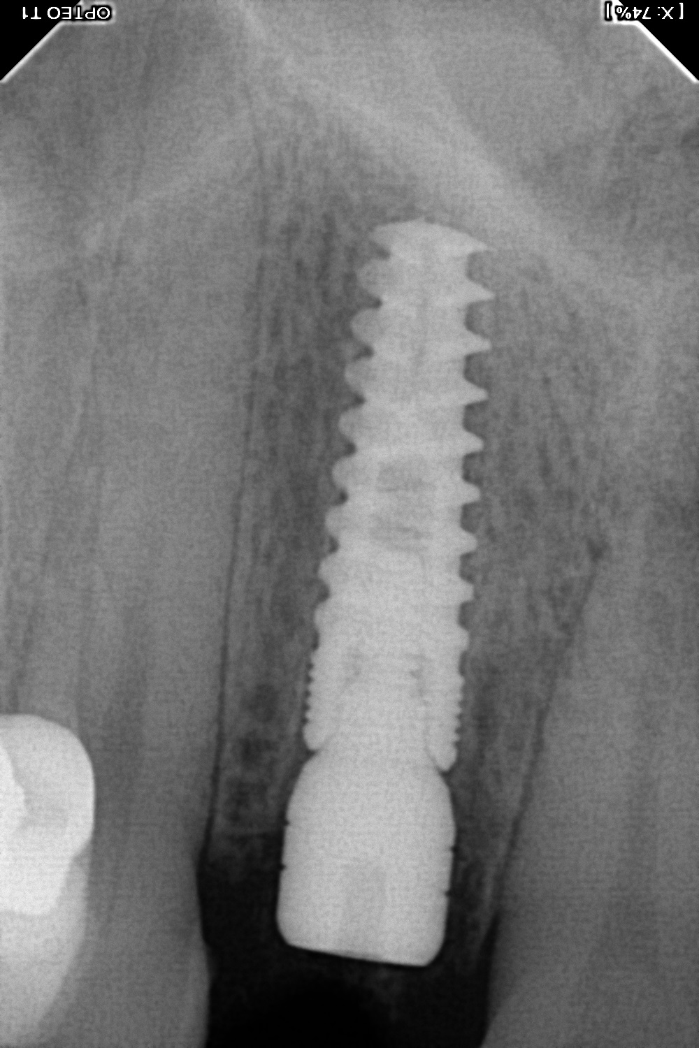 سنسور رادیوگرافی تک دندان مدل OPTEO
