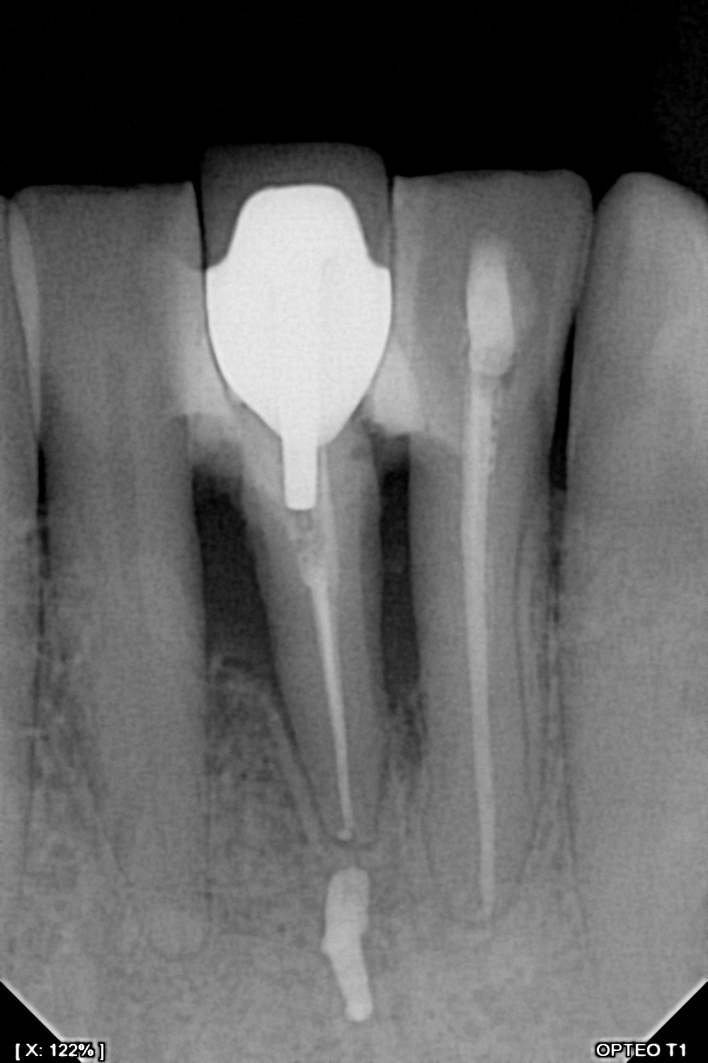 سنسور رادیوگرافی تک دندان مدل OPTEO