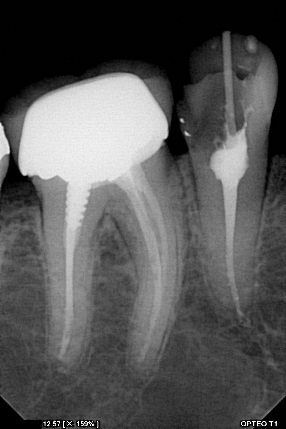 سنسور رادیوگرافی تک دندان مدل OPTEO