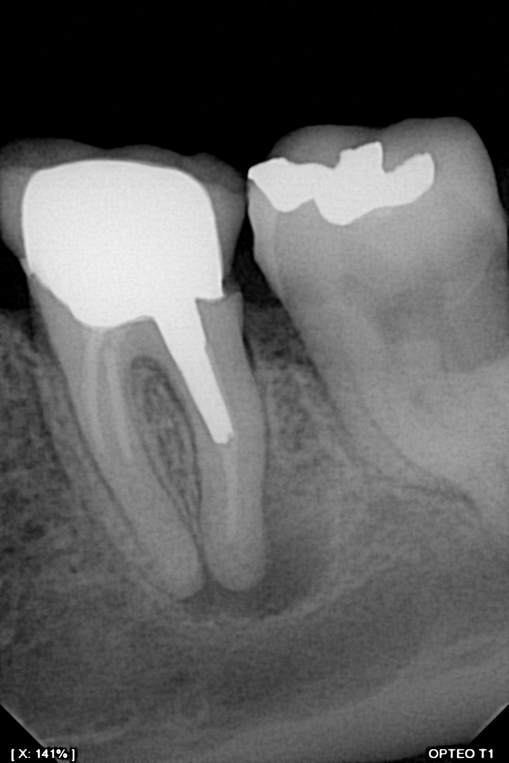 سنسور رادیوگرافی تک دندان مدل OPTEO