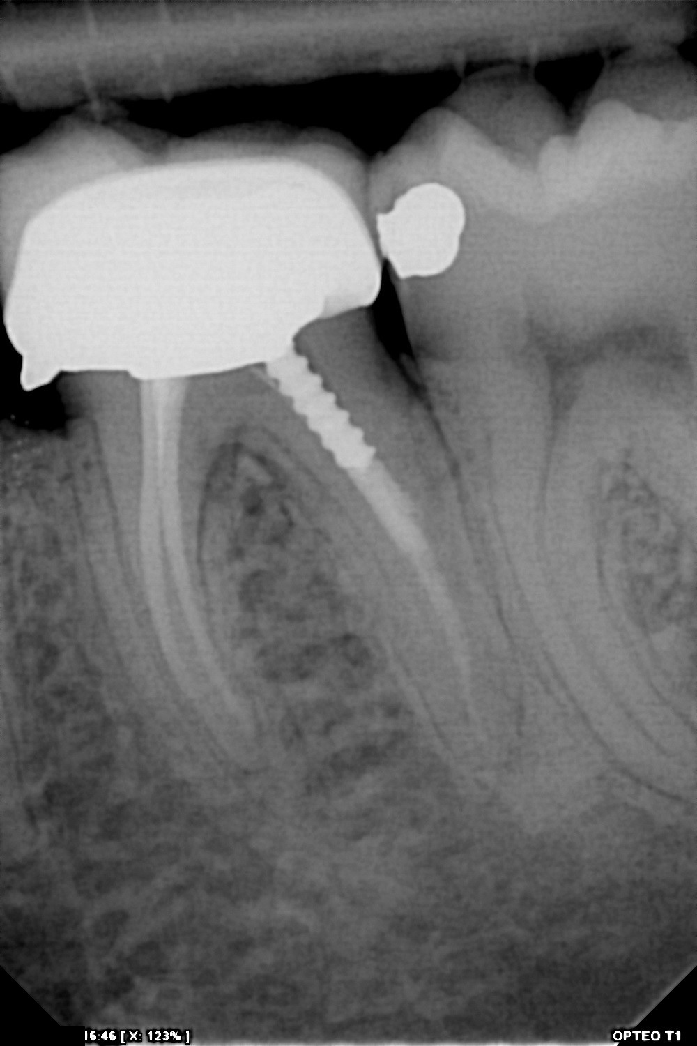سنسور رادیوگرافی تک دندان مدل OPTEO