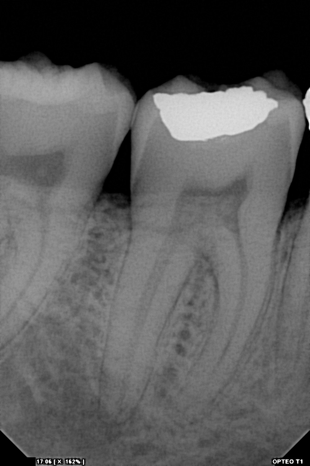 سنسور رادیوگرافی تک دندان مدل OPTEO