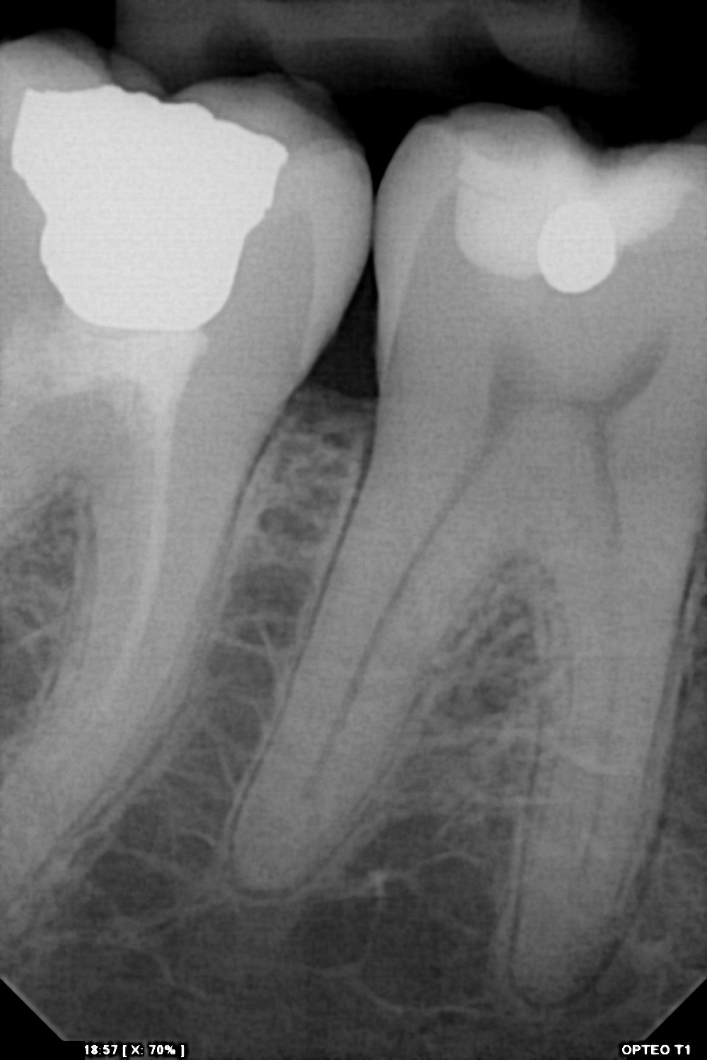 سنسور رادیوگرافی تک دندان مدل OPTEO
